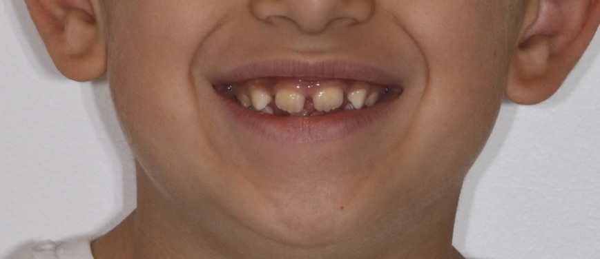 Studio Odontoiatrico Bebi Lorini - Casi prima e dopo